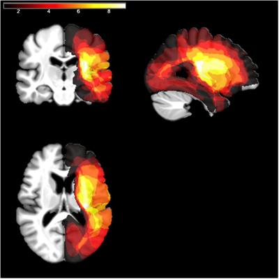 Ipsilesional Impairments of Visual Awareness After Right-Hemispheric Stroke